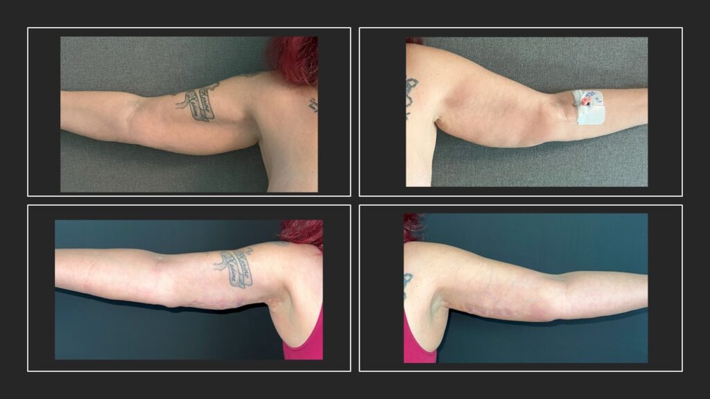 Vorher Nachher Armstraffung Istanbul