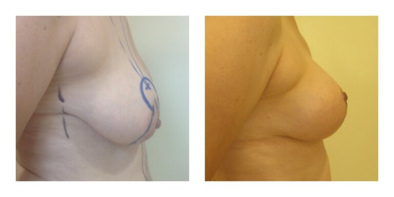 Vorher Nachher Bruststraffung Istanbul