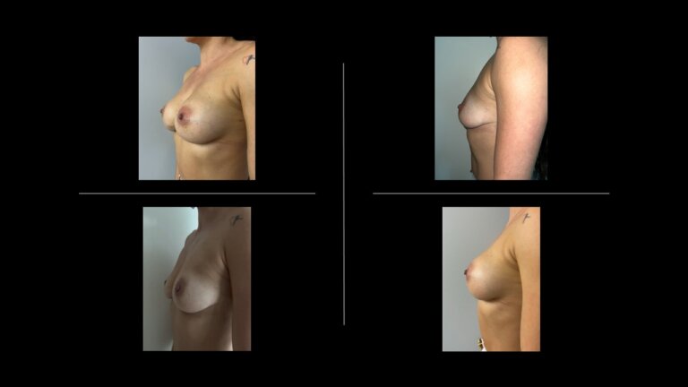 Vorher Nachher Brustimplantate Istanbul