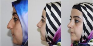 Vorher-Nachher Nasenästhetik Istanbul