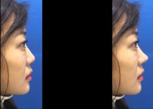 Vorher-Nachher Nasenkorrektur Istanbul