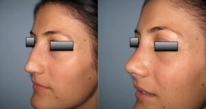 Vorher-Nachher Nasenchirurgie Istanbul